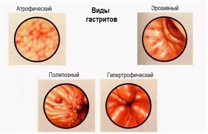 гиперпластический гастрит что это такое
