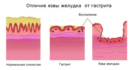 язва или гастрит