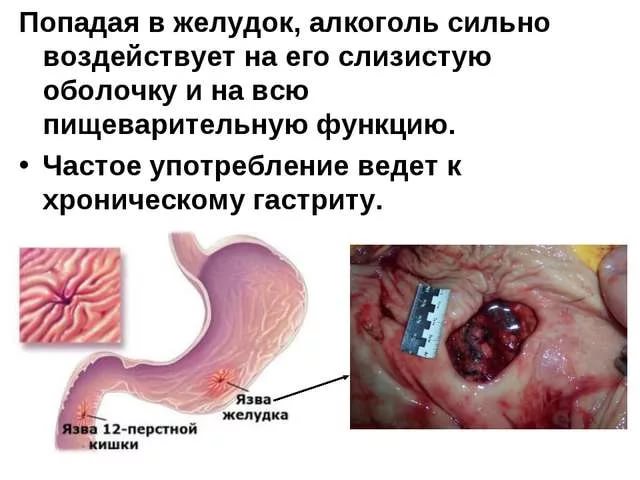 алкоголь при гастрите
