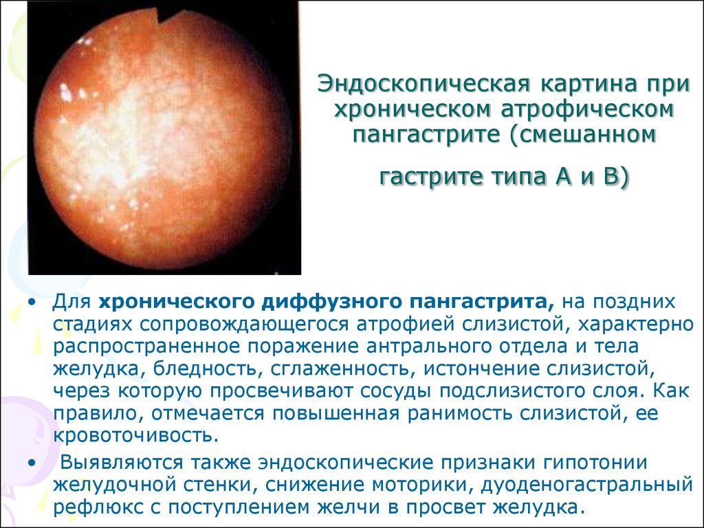 атрофический гиперпластический гастрит