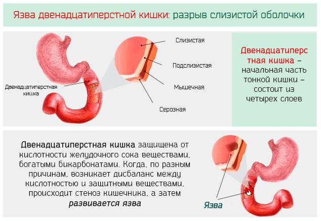 язва кишечника