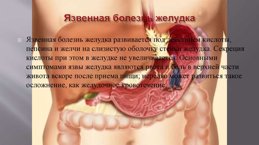 водка при язве желудка