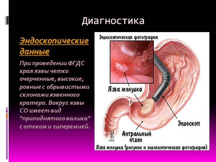 признаки язвы желудка