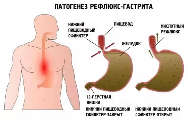 рефлюкс гастрит симптомы и лечение