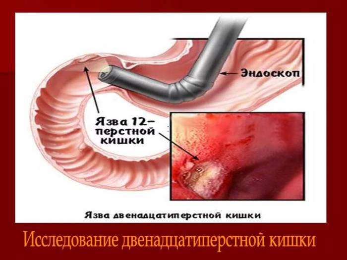 язва двенадцатиперстной кишки