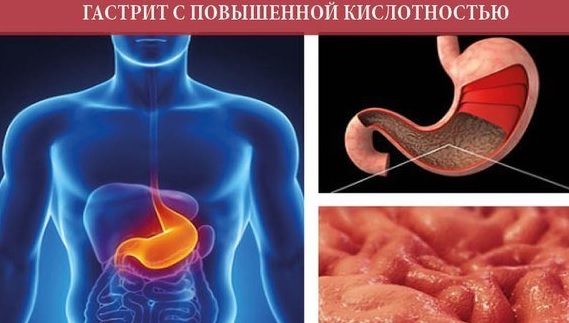 гастрит с повышенной кислотностью