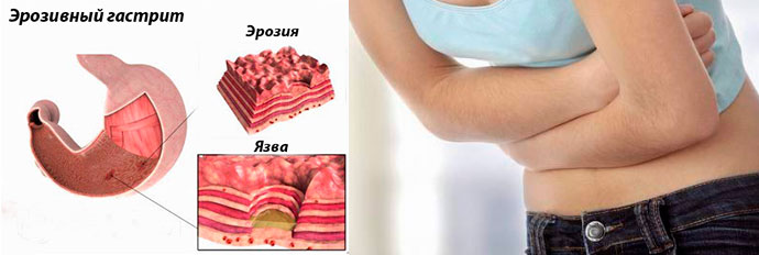 хронический эрозивный гастрит