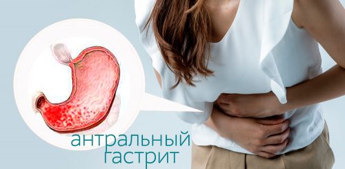 антральный гастрит
