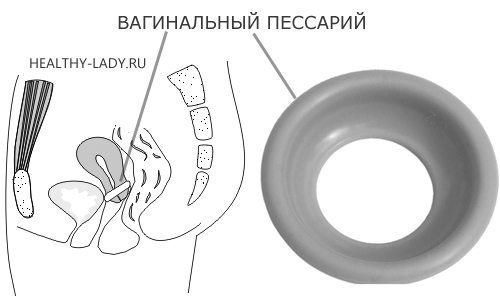 вагинальный пессарий вагинальный пессарий