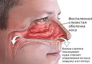 Воспаление носа Причины воспаления слизистой носа