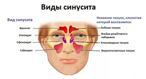 Острый пансинусит Прчиины заболевания пансинусита