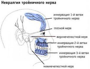 Воспаление тройничного нерва Невралгия тройничного нерва