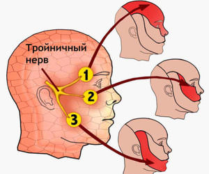 Симптомы воспаления тройничного нерва Какие признаки при воспалении нерва