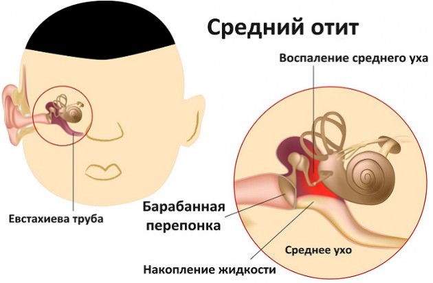 Средний отит Клиника заболевания