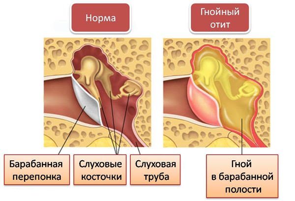 Гнойная форма отита Клиника заболевания