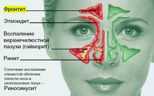 Что такое риносинусит Описание воспалительного заболевания носовой полости риносинусита