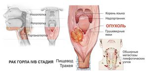 Лечение опухоли горла Симптомы опухоли горла