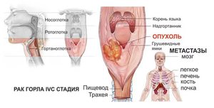 Диагностирование заболевания Как лечить опухоль горла