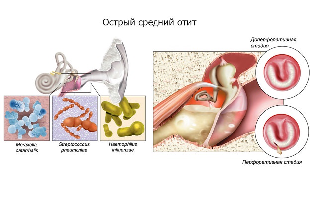 Отит среднего уха Заболевание уха