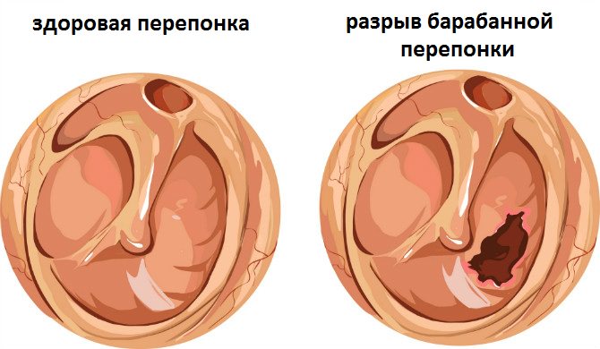 Перфорация барабанной перепонки Разрыв перепонки при отите