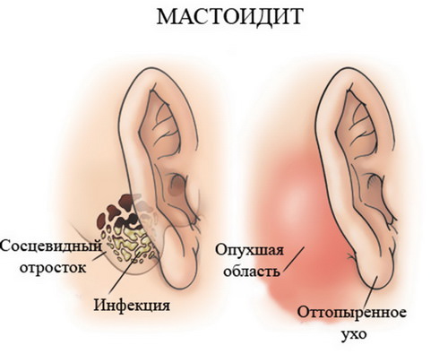 Мастоидит уха Осложнение отита