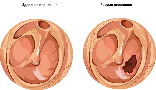 Разрыв барабанной перепони Дефект перепонки как причина боли