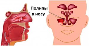 Полипы в носу Полопы