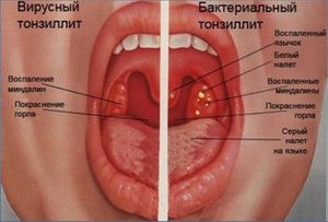Больные миндалины Больные миндалины