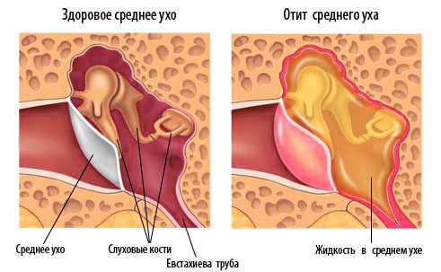 Перекись водорода и отит Перекись водорода и отит